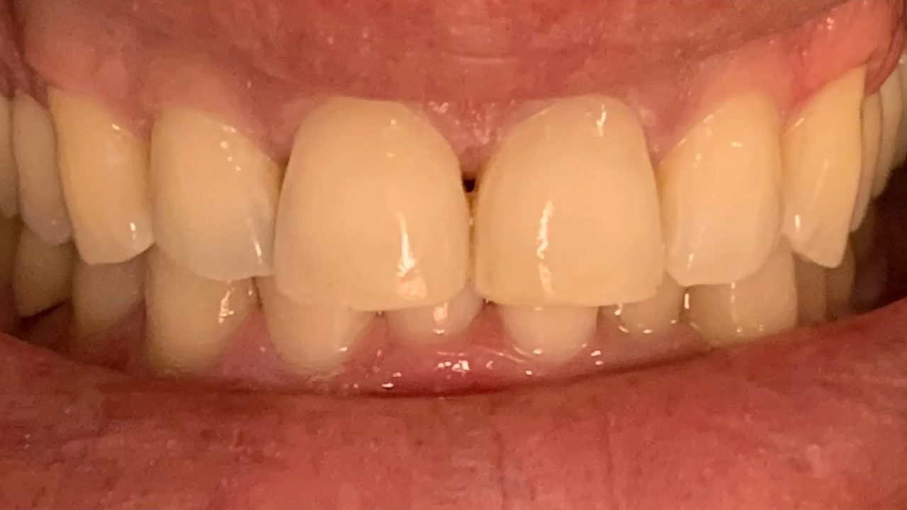 Smile case 1 after treatment at Rovel Dental