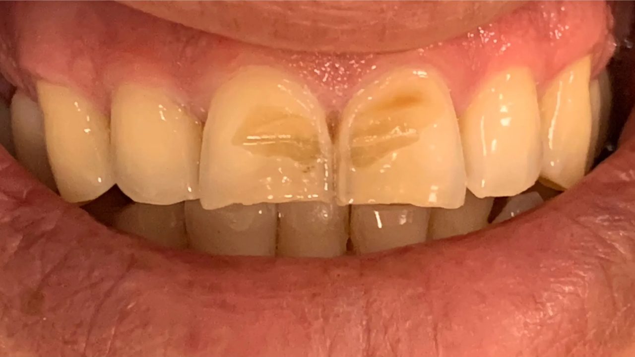 Smile case 1 before treatment