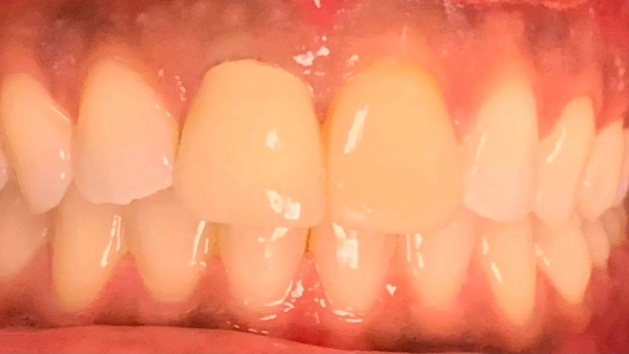 Smile case 2 before treatment