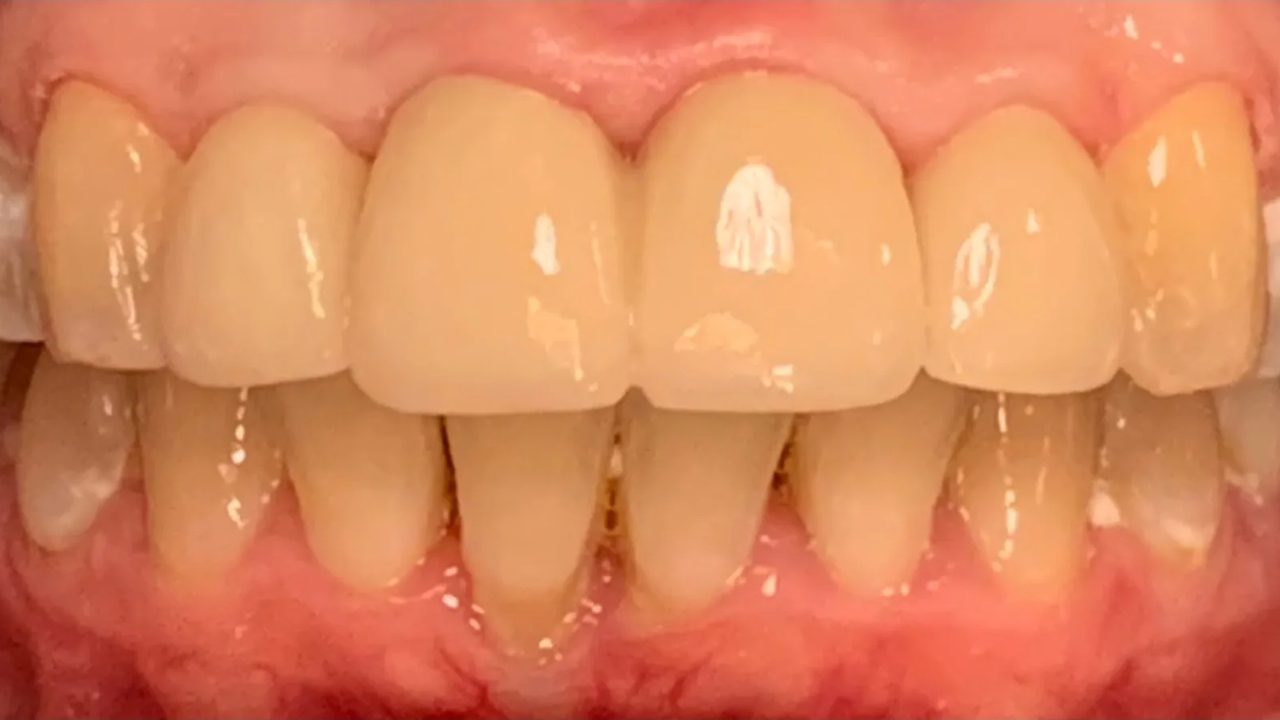 Smile case 3 after treatment at Rovel Dental