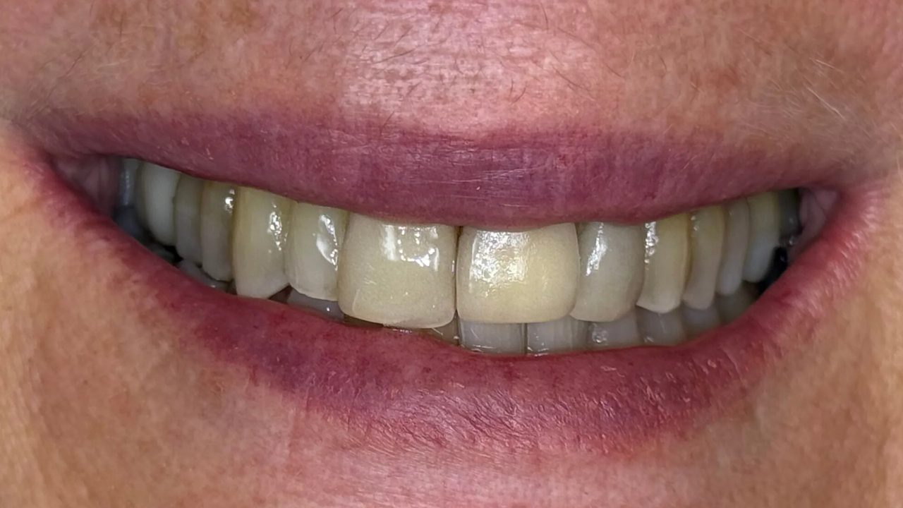 Smile case 6 before treatment