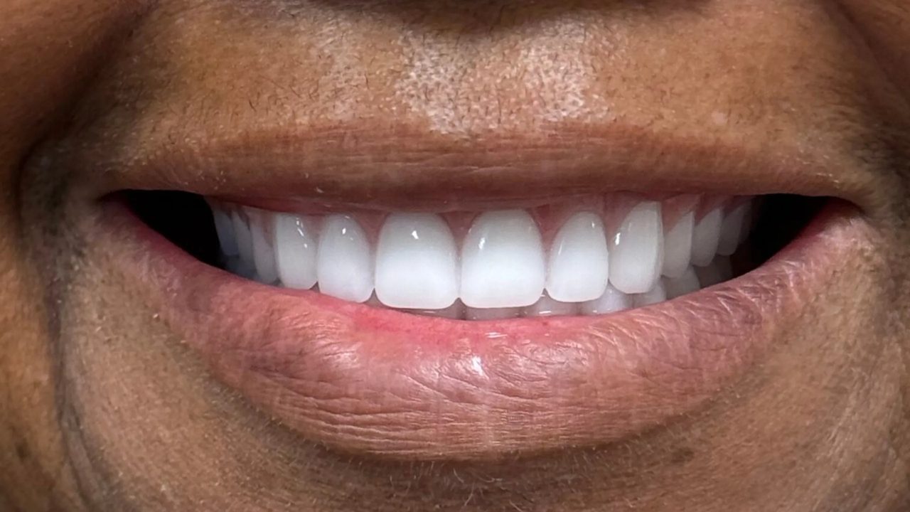 Smile case 7 after treatment at Rovel Dental