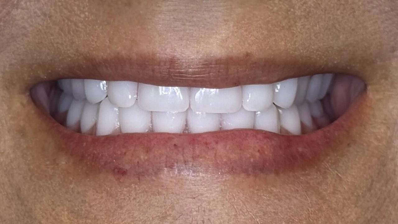 Smile case 8 after treatment at Rovel Dental
