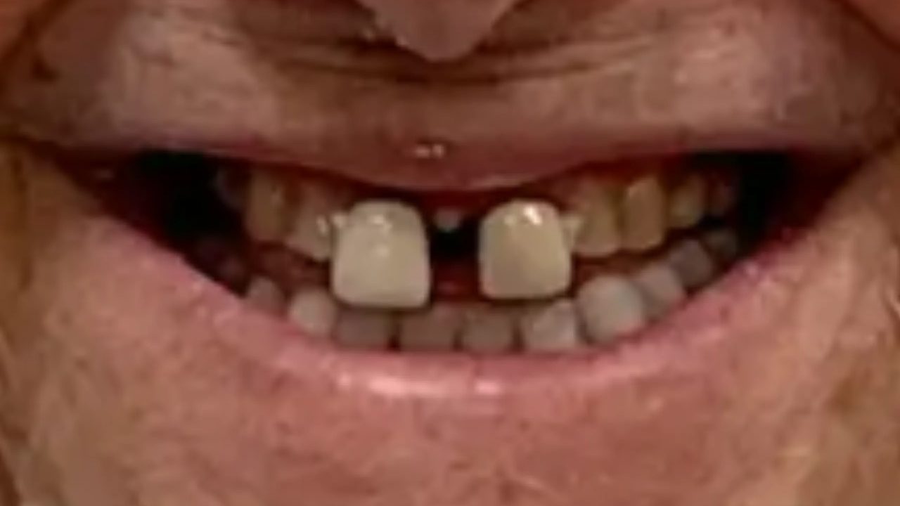 Smile case 9 before treatment