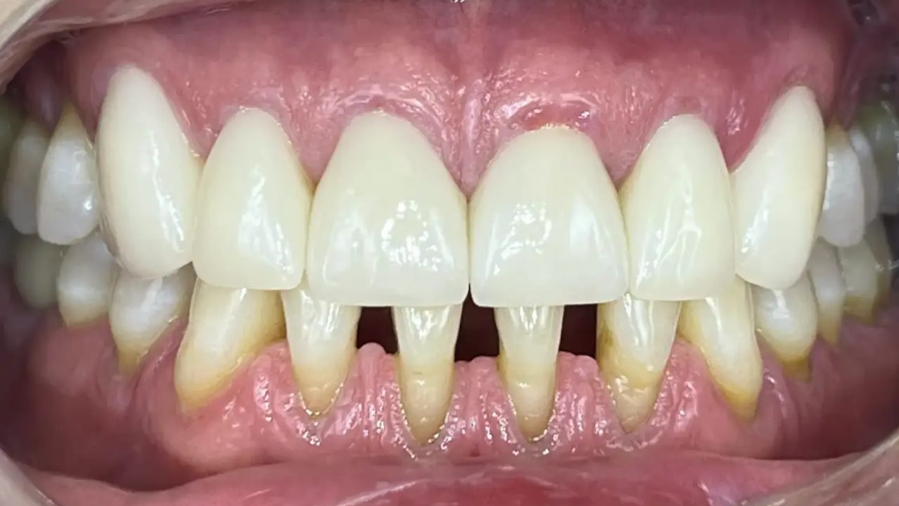 Smile case 10 after treatment at Rovel Dental