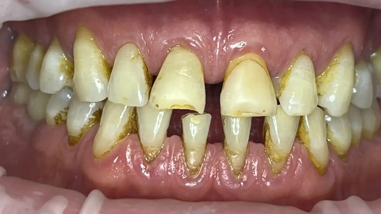 Smile case 10 before treatment