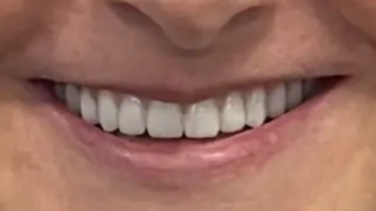 Smile case 11 after treatment at Rovel Dental