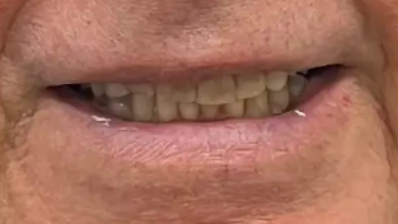 Smile case 12 before treatment