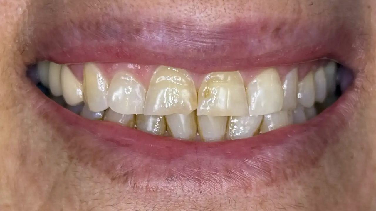 Smile case 13 before treatment