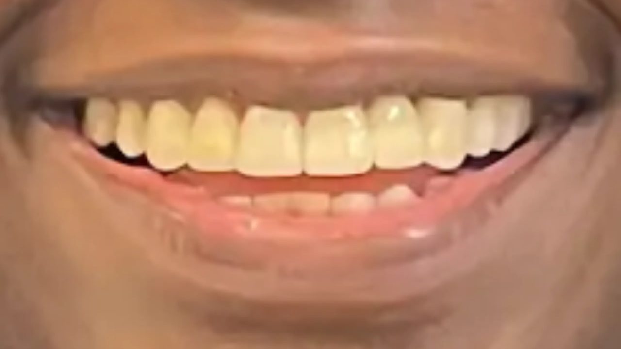 Smile case 14 after treatment at Rovel Dental