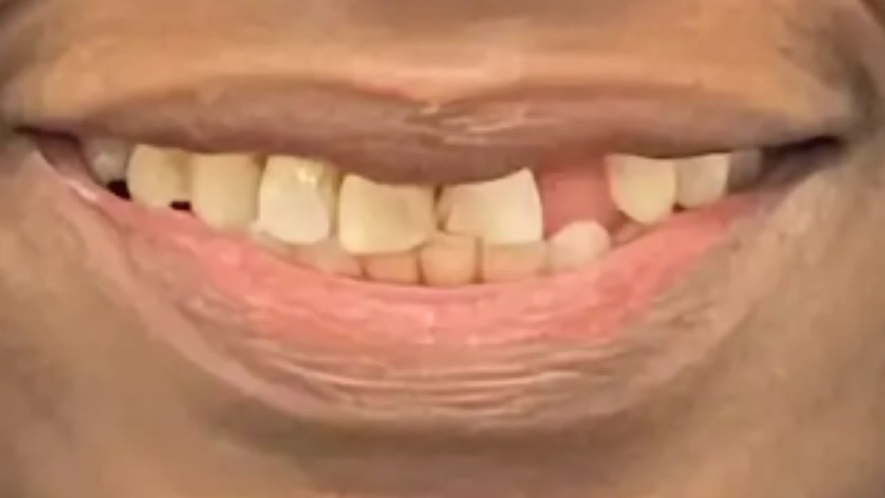 Smile case 14 before treatment