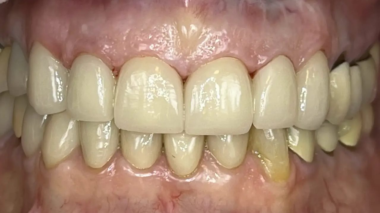 Smile case 15 after treatment at Rovel Dental