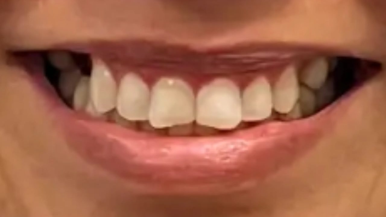Smile case 16 before treatment