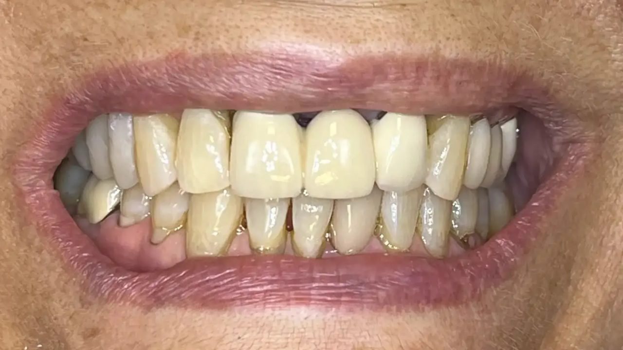 Smile case 17 before treatment