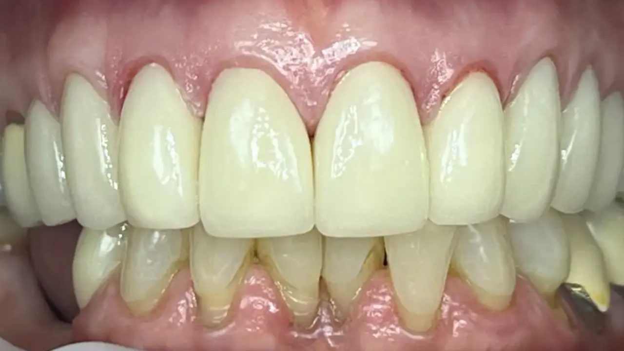 Smile case 18 after treatment at Rovel Dental