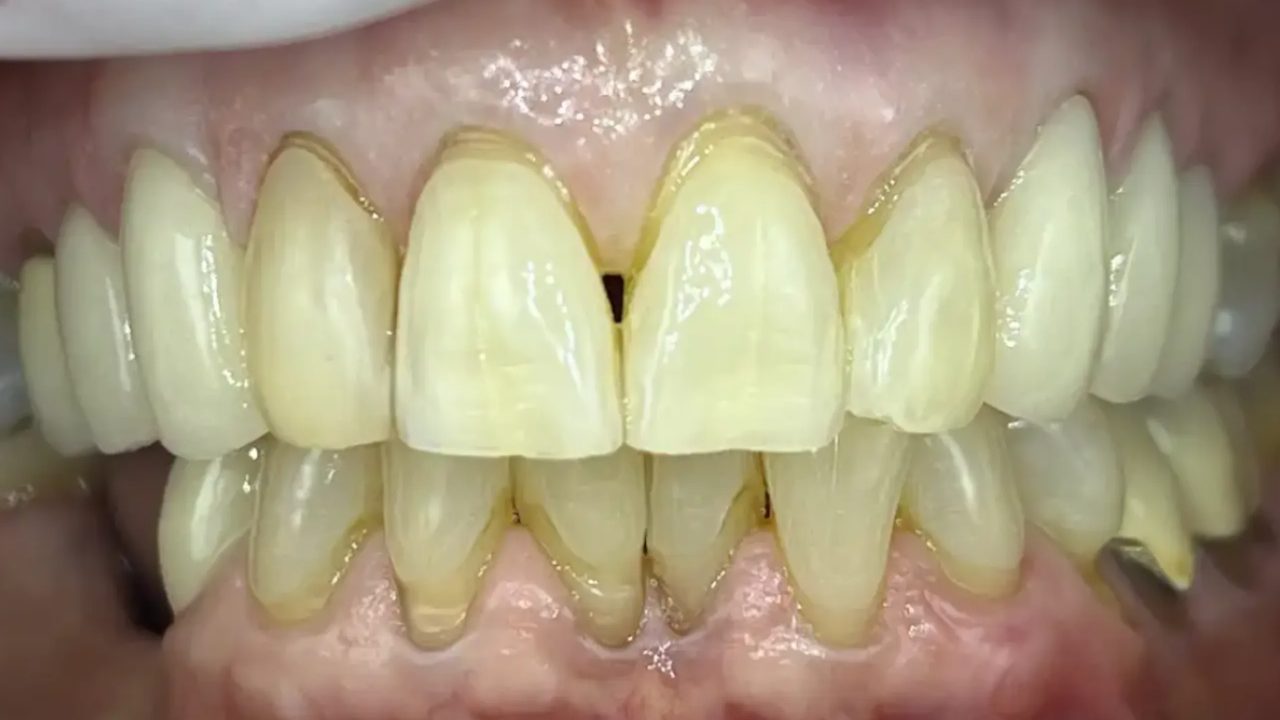 Smile case 18 before treatment